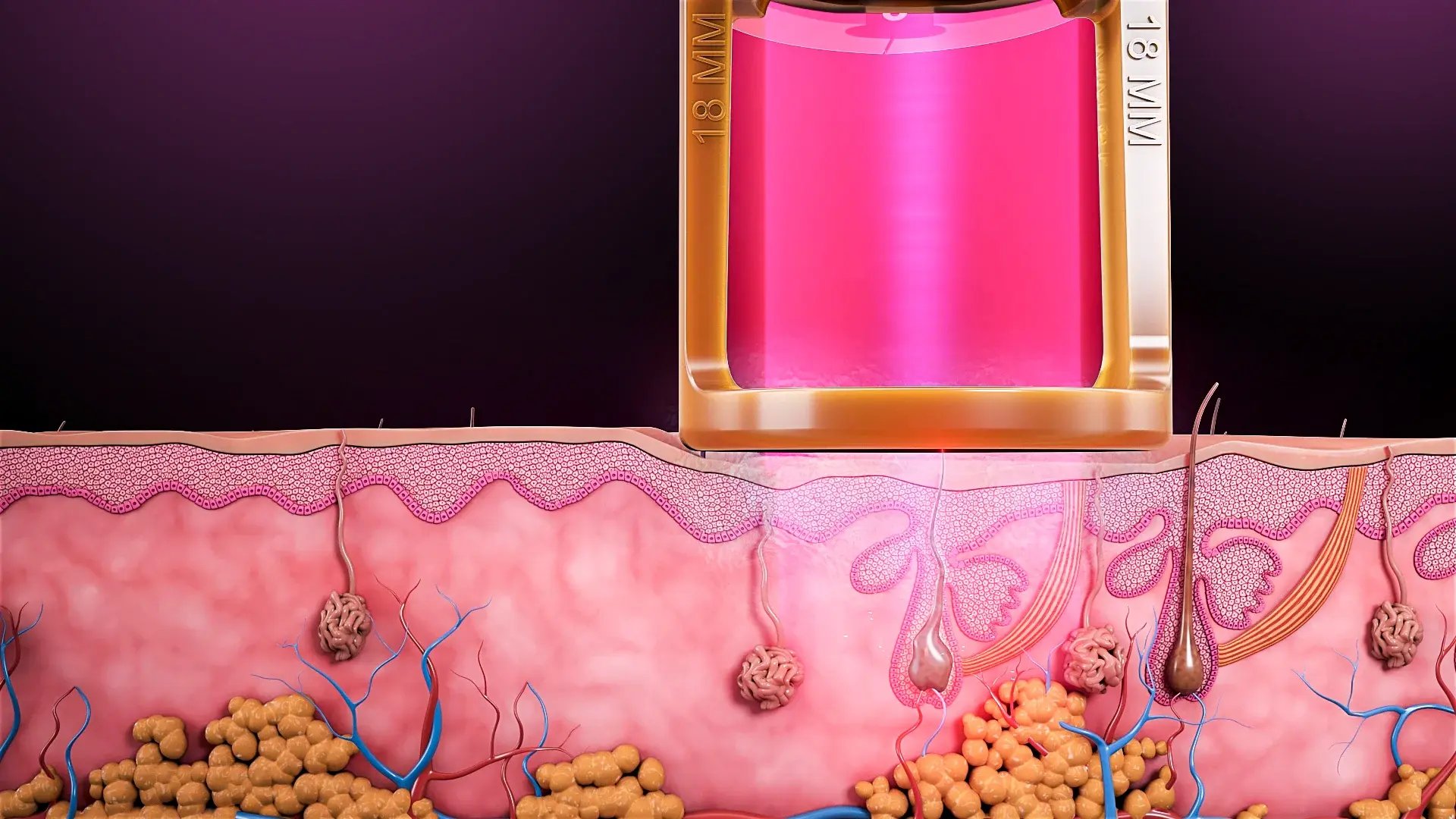 alexandrite-epilation-rayon-ndyag-yety-homme