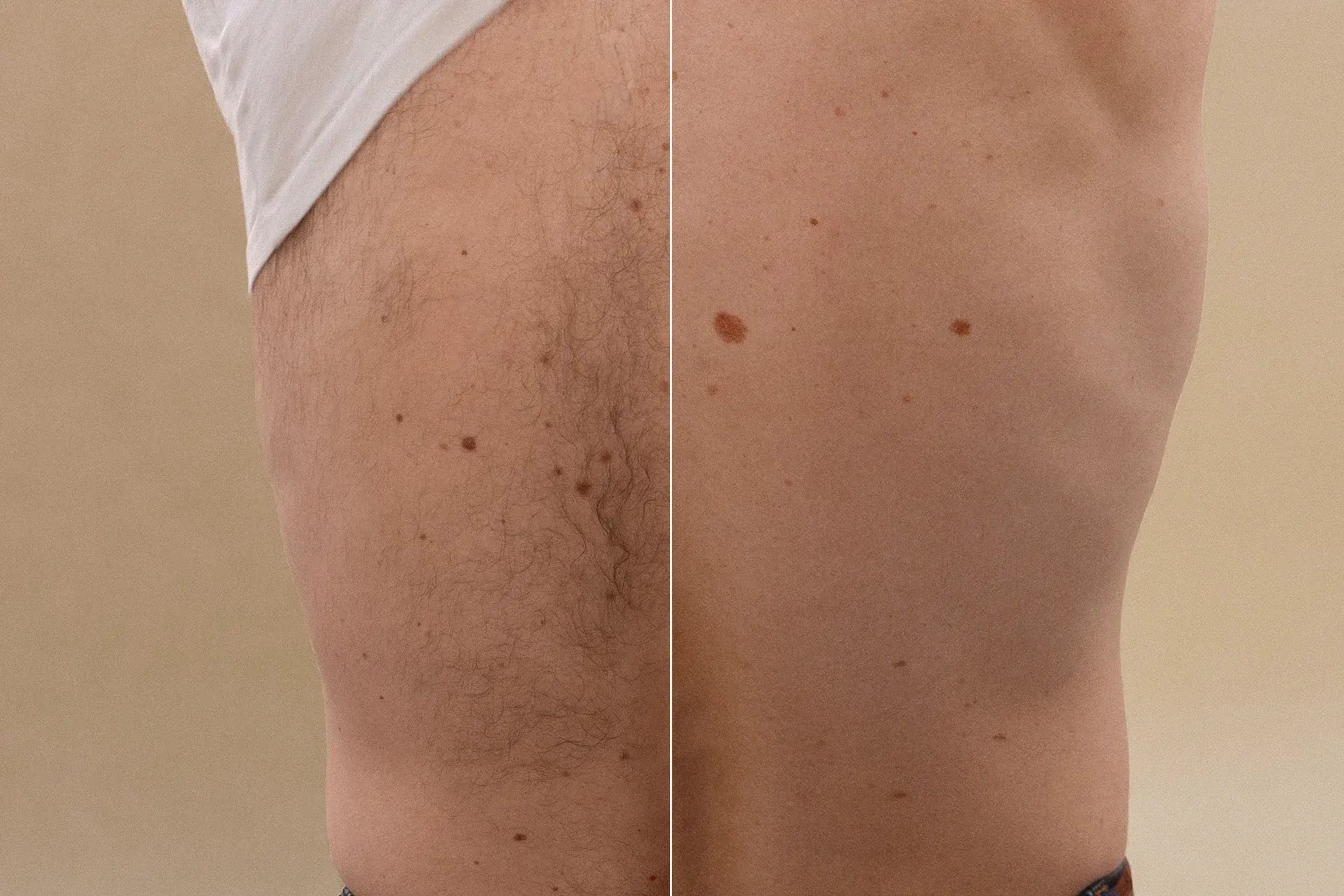 avant-apres-homme-epilation-laser-paris