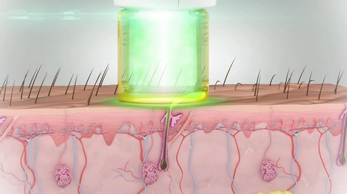 Le processus d'épilation laser et son rayon sur la peau, sécurité et sureté