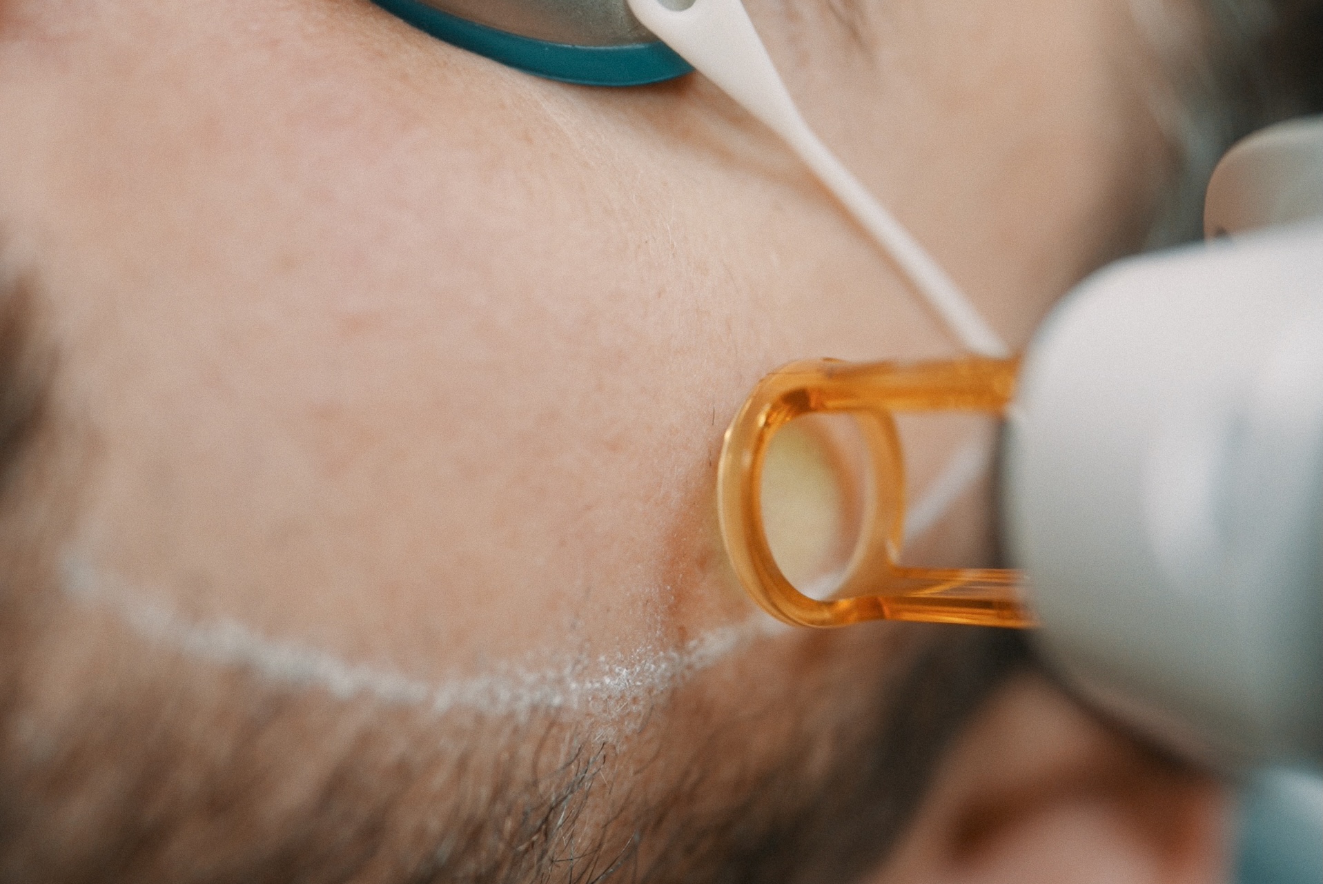 Épilation laser de contour de barbe: la nouvelle solution pour les hommes en 2026