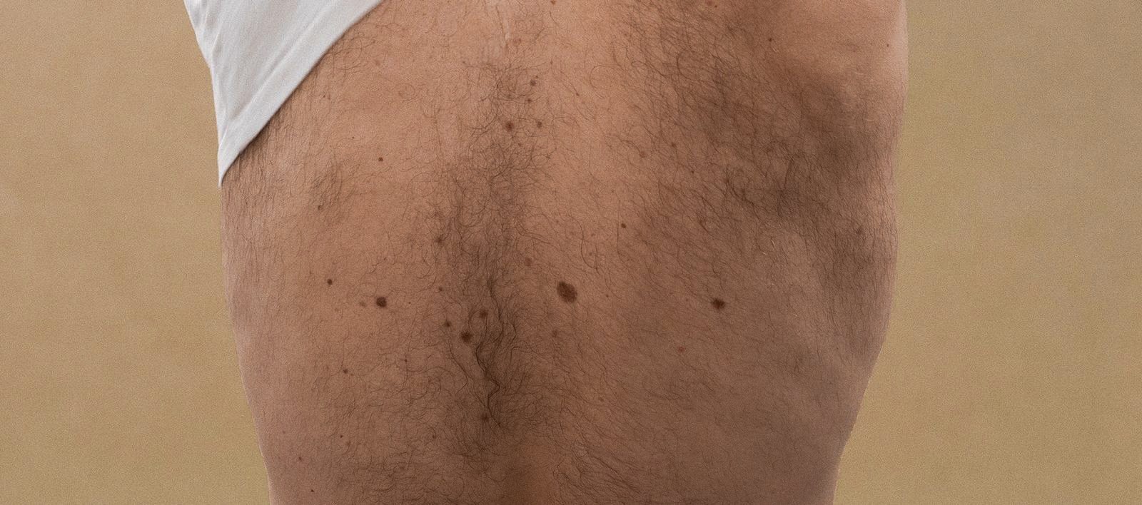 laser-epilation-avant-apres-paris-homme