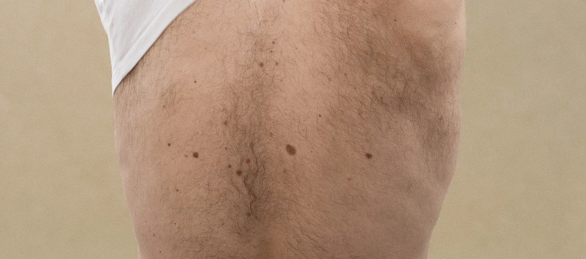 laser-epilation-avant-apres-paris-homme