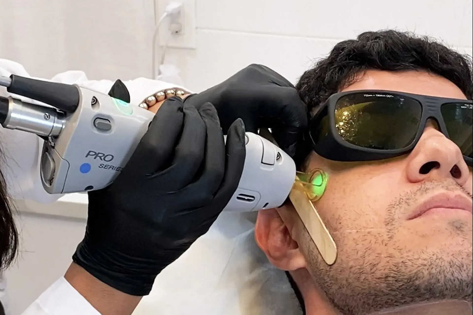 Combien de séances d'épilation laser faut-il pour un homme ?