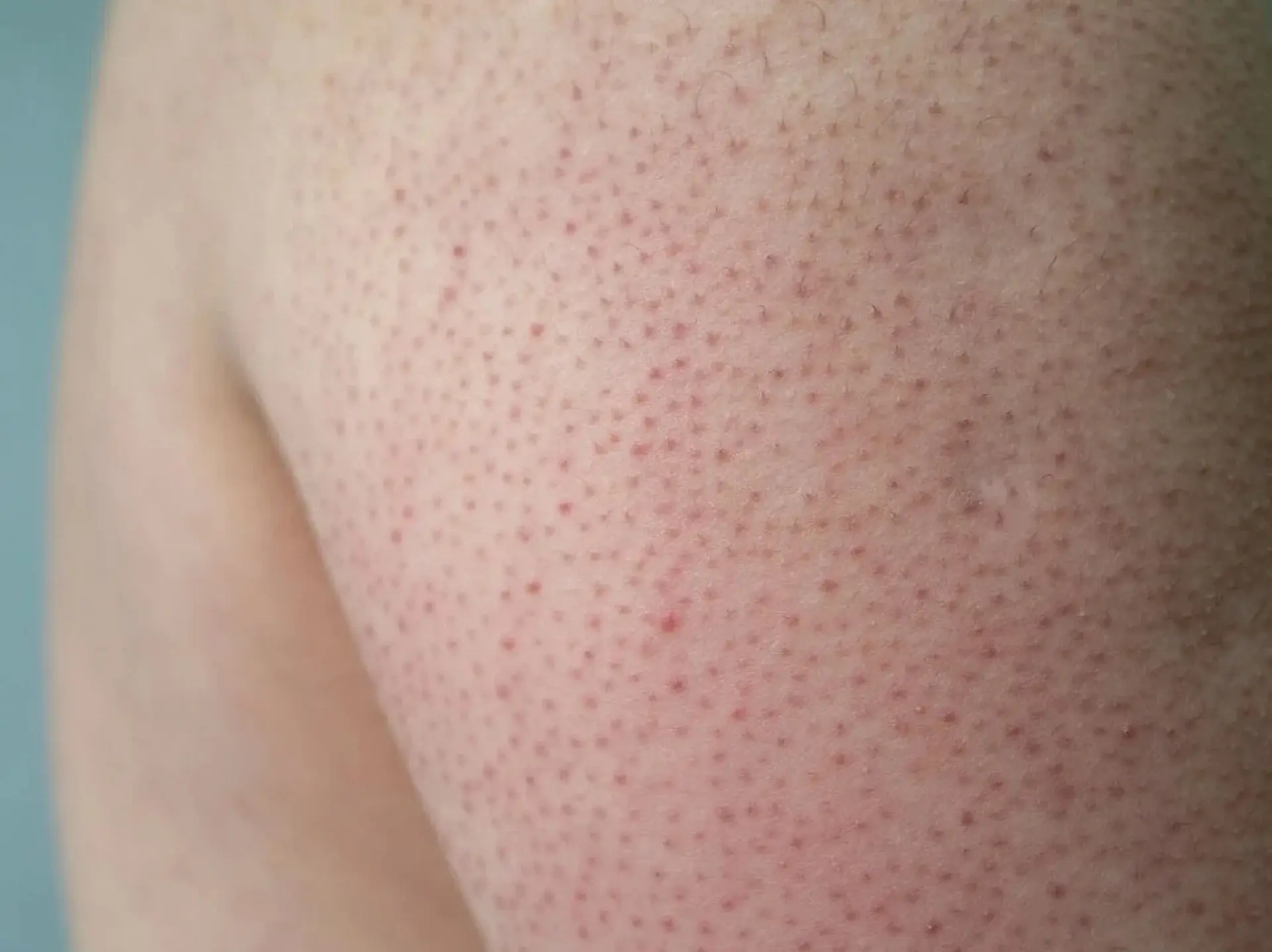Le traitement de la kératose pilaire avec le laser